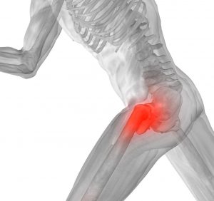 GROIN PAIN - LEISTENSCHMERZ IM SPORT